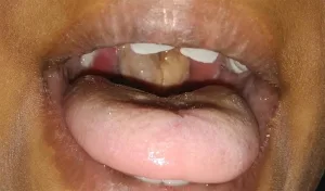 Diphtheria: Benue heightens surveillance as cases rise across Nigeria
